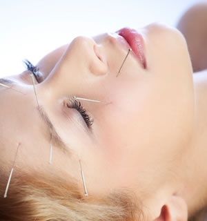 Akupunktur